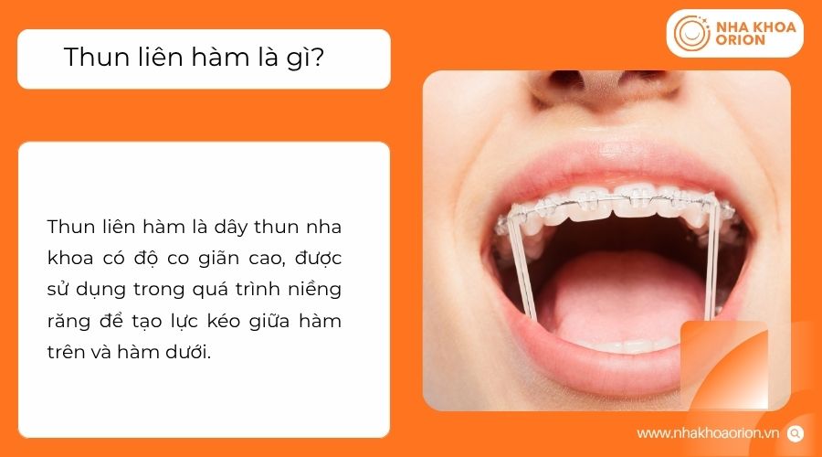 Thun li&ecirc;n h&agrave;m tạo lực k&eacute;o giữa hai h&agrave;m để hỗ trợ điều chỉnh khớp cắn