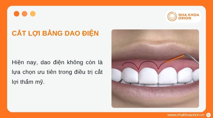 Dao điện hiện &iacute;t được sử dụng trong điều trị cắt lợi