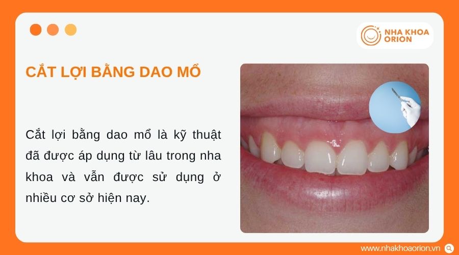 Dao mổ l&agrave; một trong những phương ph&aacute;p cắt lợi truyền thống hiện nay