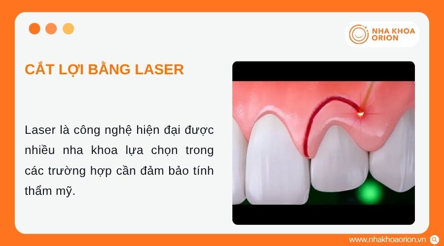 Laser gi&uacute;p loại bỏ m&ocirc; nướu ch&iacute;nh x&aacute;c v&agrave; hạn chế chảy m&aacute;u