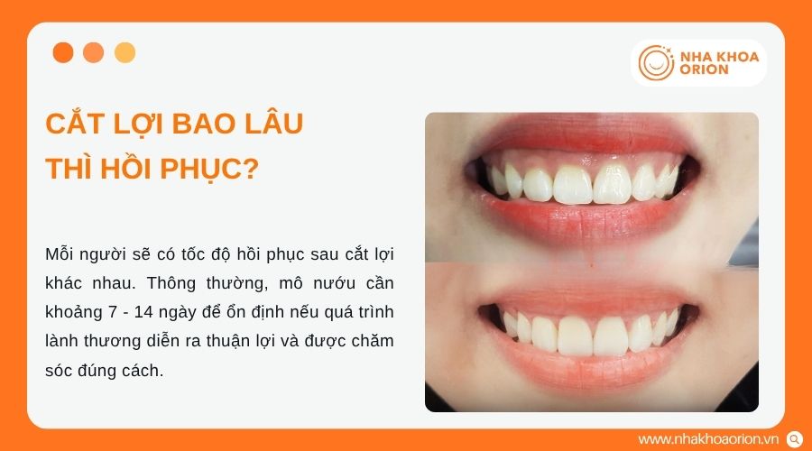 Thời gian hồi phục sau cắt lợi phụ thuộc v&agrave;o từng trường hợp