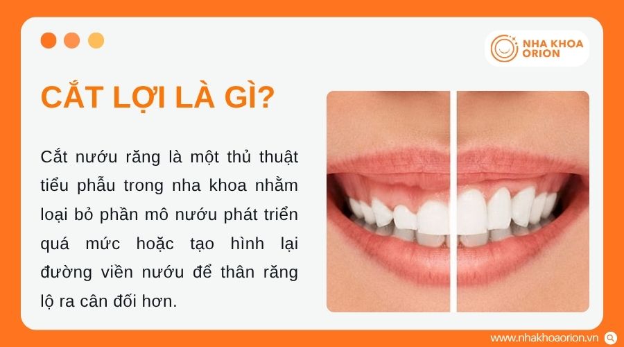 Cắt lợi gi&uacute;p điều chỉnh m&ocirc; nướu v&agrave; cải thiện thẩm mỹ nụ cười