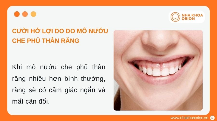 Cắt lợi gi&uacute;p cải thiện t&igrave;nh trạng cười hở lợi hiệu quả