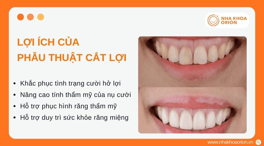 Cắt lợi mang lại nhiều lợi &iacute;ch về thẩm mỹ v&agrave; sức khỏe răng miệng
