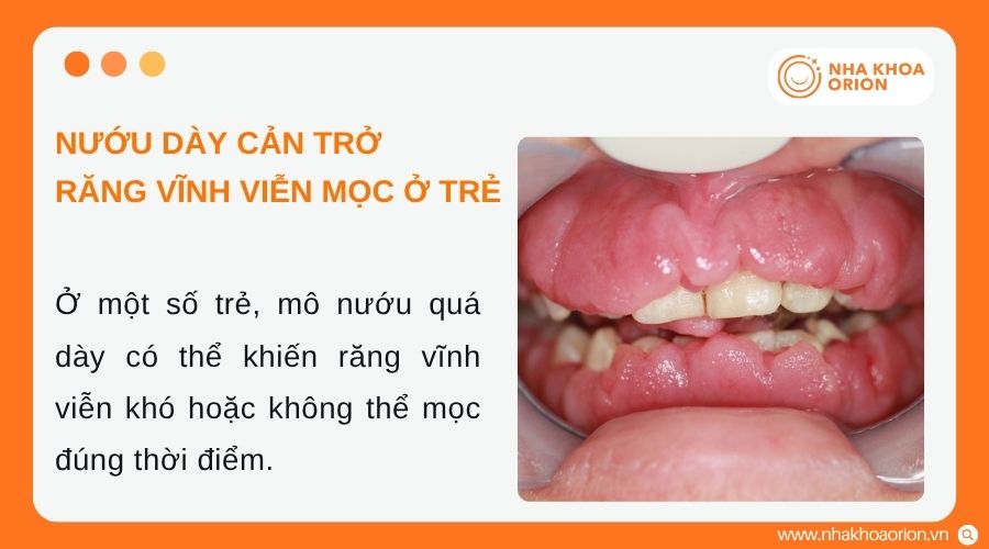 B&aacute;c sĩ sẽ chỉ định cắt lợi khi nướu cản trở răng mọc ở trẻ