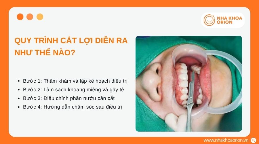 Quy tr&igrave;nh cắt lợi gồm nhiều bước nhằm đảm bảo an to&agrave;n điều trị
