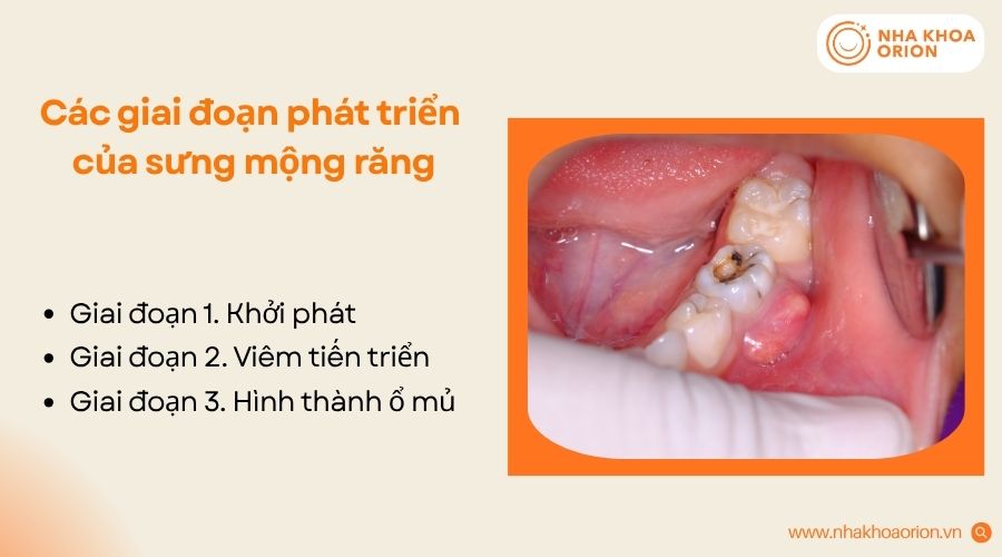 Sưng mộng răng thường tiến triển qua ba giai đoạn, từ kích ứng nhẹ đến hình thành ổ mủ