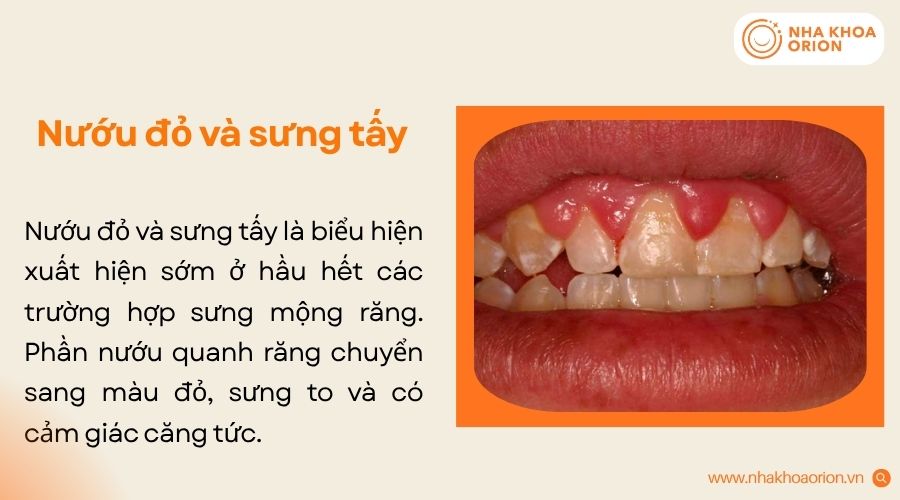 Nướu viêm thường đỏ, căng phồng, nhạy cảm và dễ chảy máu khi vệ sinh hoặc ăn nhai