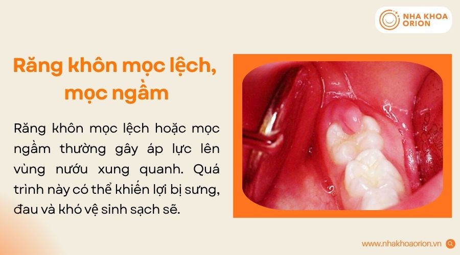 Răng khôn mọc lệch hoặc mọc ngầm thường gây chèn ép, viêm nướu và tích tụ thức ăn