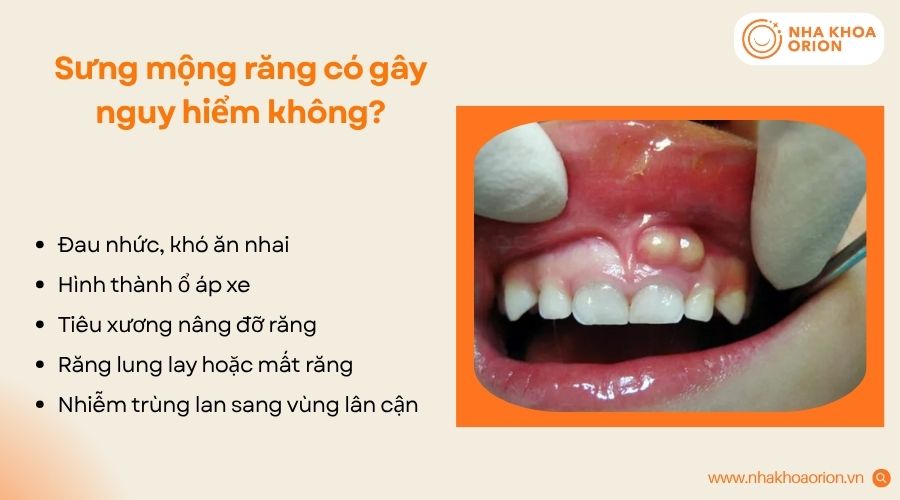 Sưng mộng răng không được điều trị sớm có thể gây áp xe, tiêu xương hoặc mất răng
