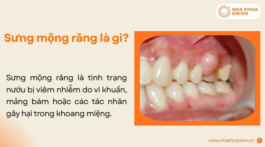Sưng mộng răng xảy ra khi nướu viêm, sưng đau và có thể xuất hiện ổ mủ