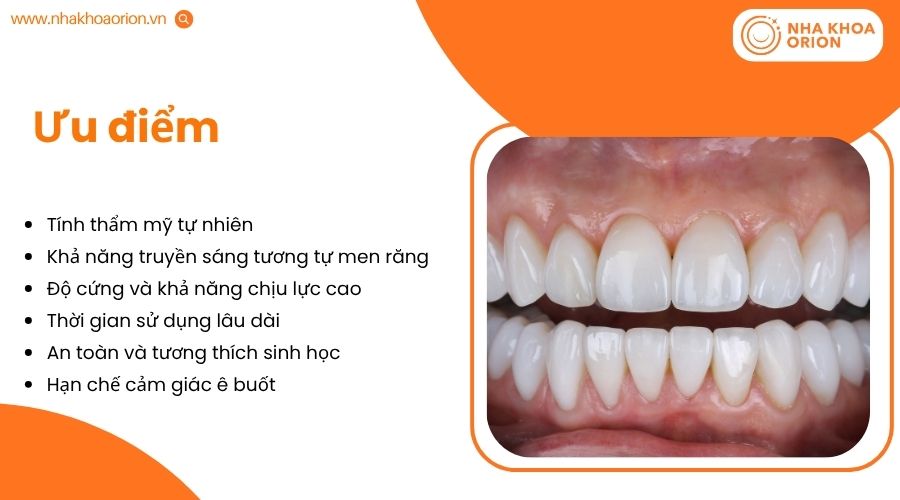 Răng toàn sứ nổi bật về thẩm mỹ, độ bền và an toàn