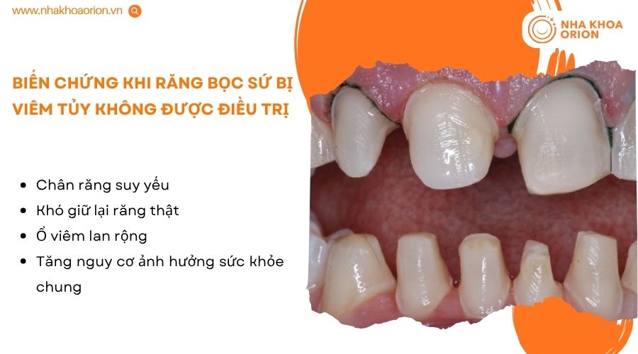 Điều trị sớm gi&uacute;p hạn chế nguy cơ mất răng v&agrave; c&aacute;c biến chứng kh&aacute;c