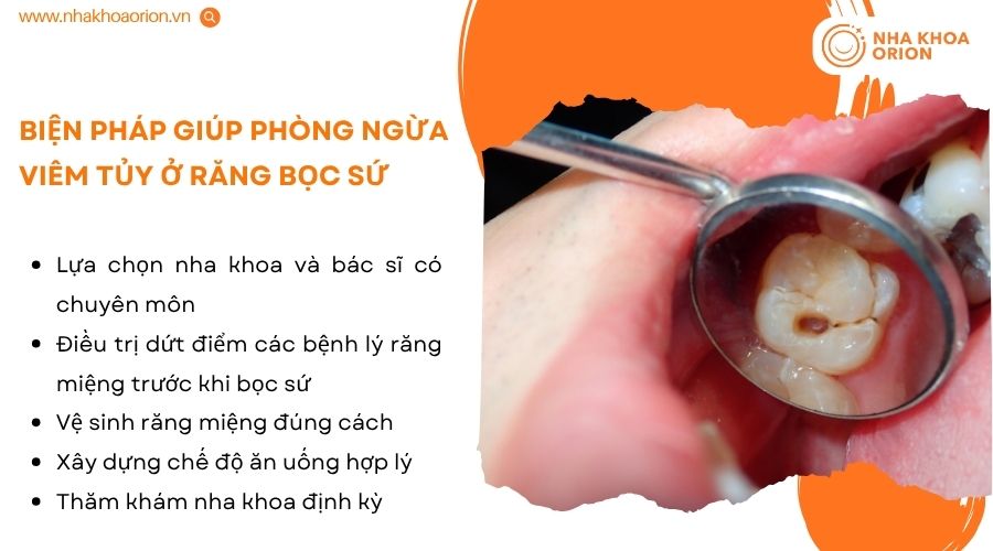 Chăm s&oacute;c đ&uacute;ng c&aacute;ch gi&uacute;p giảm nguy cơ vi&ecirc;m tủy v&agrave; k&eacute;o d&agrave;i tuổi thọ răng sứ