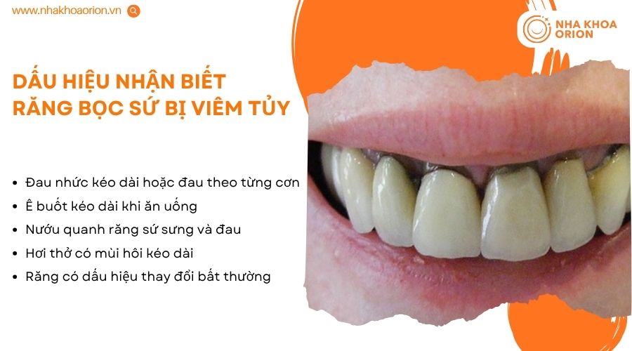 Đau nhức, &ecirc; buốt k&eacute;o d&agrave;i l&agrave; dấu hiệu cảnh b&aacute;o răng bọc sứ c&oacute; thể bị vi&ecirc;m tủy