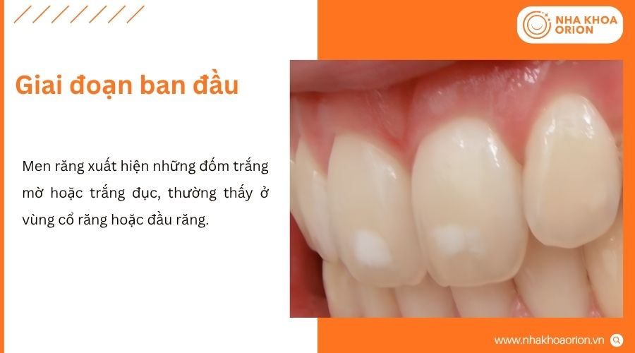 C&aacute;c dấu hiệu chỉ mới xuất hiện v&agrave; thường kh&oacute; nhận biết bằng mắt thường