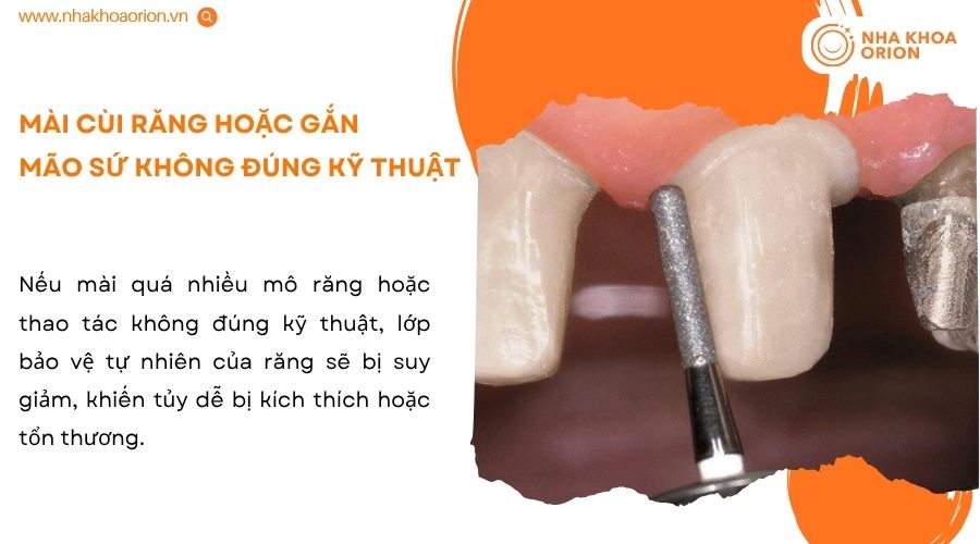M&agrave;i c&ugrave;i qu&aacute; mức hoặc gắn m&atilde;o sứ kh&ocirc;ng kh&iacute;t l&agrave;m tăng nguy cơ tổn thương tủy răng