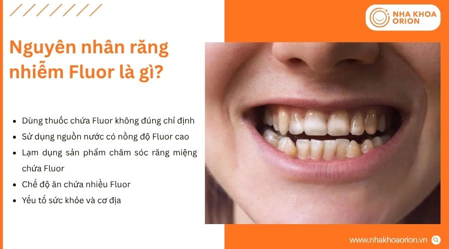 Răng nhiễm Fluor c&oacute; thể xuất ph&aacute;t từ nhiều nguy&ecirc;n nh&acirc;n kh&aacute;c nhau&nbsp;