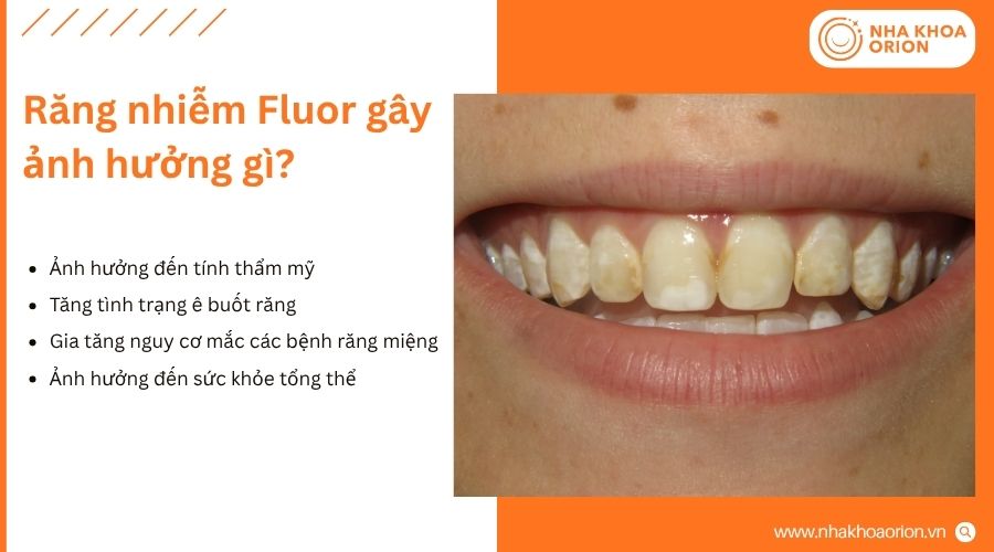 Răng nhiễm Fluor c&oacute; thể ảnh hưởng đến cả thẩm mỹ v&agrave; sức khỏe răng miệng