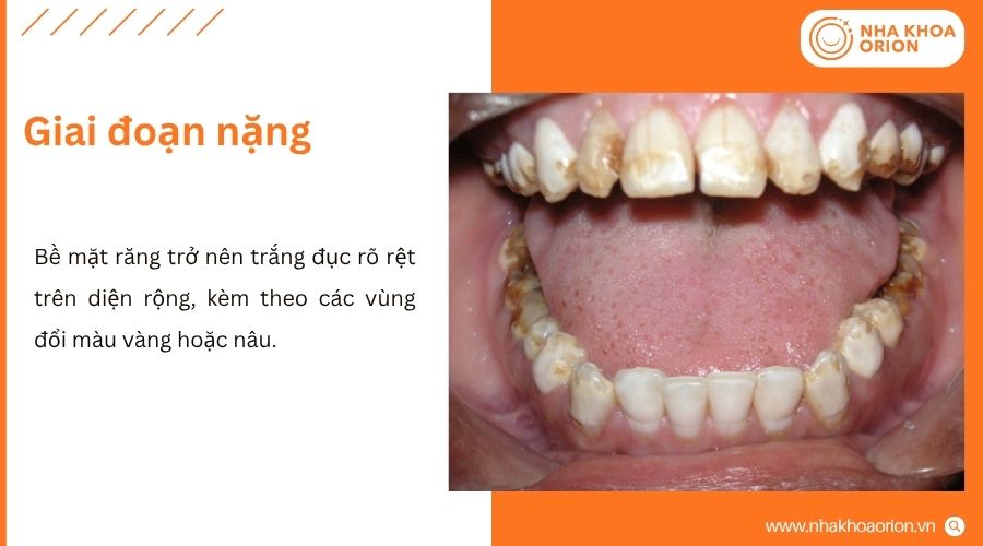 Men răng đổi m&agrave;u r&otilde; rệt, đồng thời cấu tr&uacute;c bề mặt cũng bị ảnh hưởng