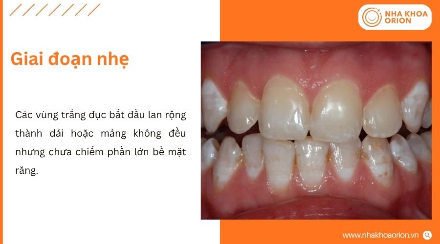 C&aacute;c đốm trắng bắt đầu lan rộng v&agrave; men răng c&oacute; sự thay đổi r&otilde; hơn