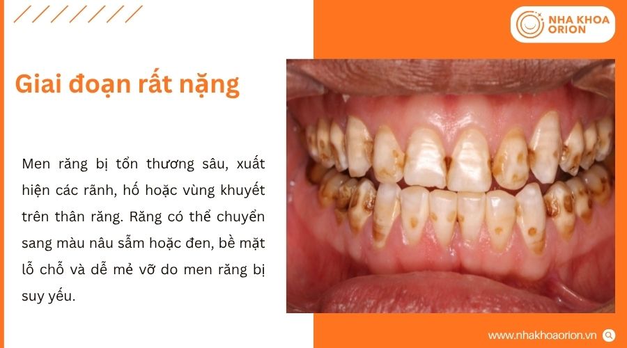 Men răng tổn thương nghi&ecirc;m trọng, ảnh hưởng đến cả thẩm mỹ v&agrave; chức năng ăn nhai