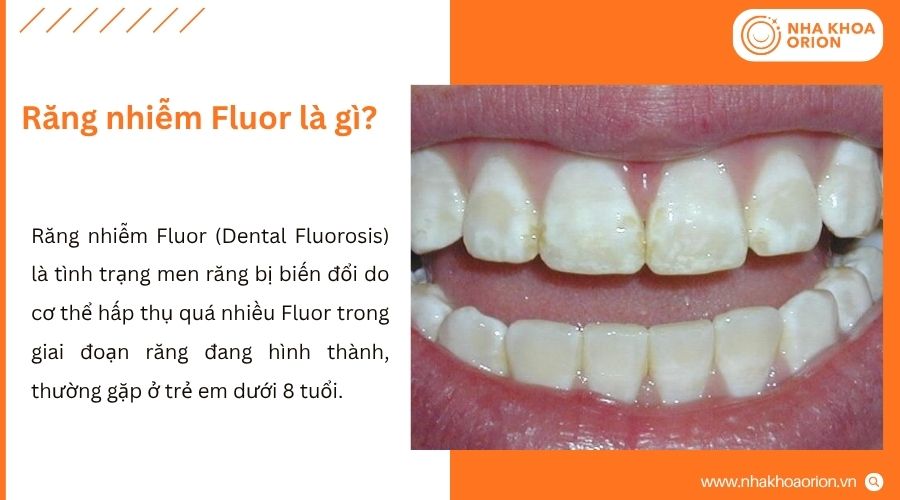 Răng nhiễm Fluor xảy ra khi cơ thể hấp thụ qu&aacute; nhiều Fluor trong giai đoạn răng ph&aacute;t triển