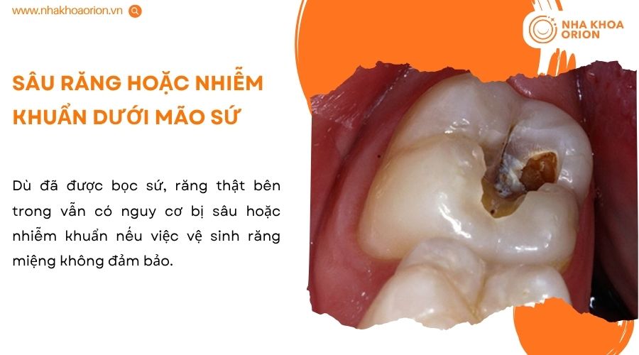 Đau nhức, &ecirc; buốt k&eacute;o d&agrave;i l&agrave; dấu hiệu cảnh b&aacute;o răng bọc sứ c&oacute; thể bị vi&ecirc;m tủy
