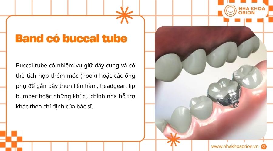 Band c&oacute; buccal tube gi&uacute;p cố định d&acirc;y cung v&agrave; kh&iacute; cụ chỉnh nha
