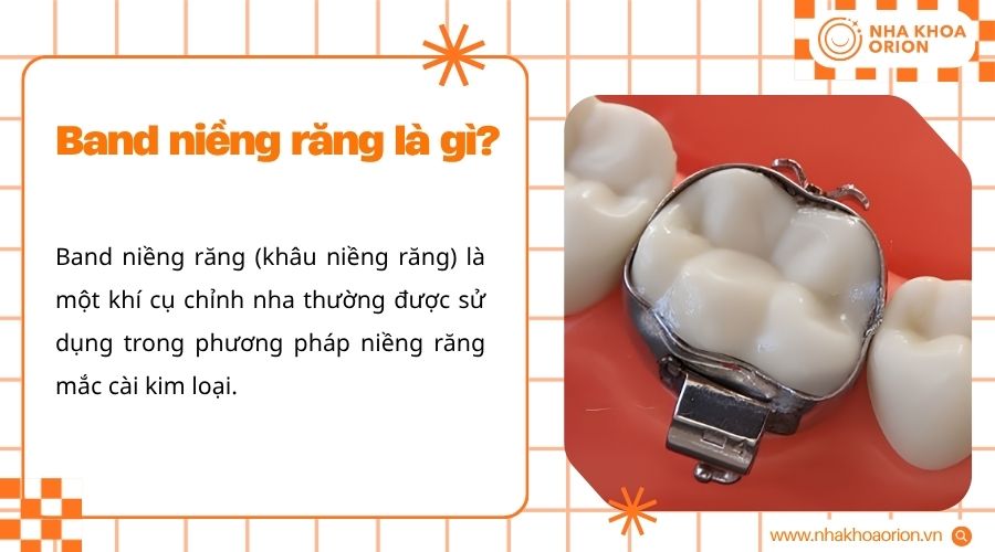 Band niềng răng l&agrave; v&ograve;ng kim loại &ocirc;m s&aacute;t răng h&agrave;m, tạo điểm neo cho hệ thống mắc c&agrave;i