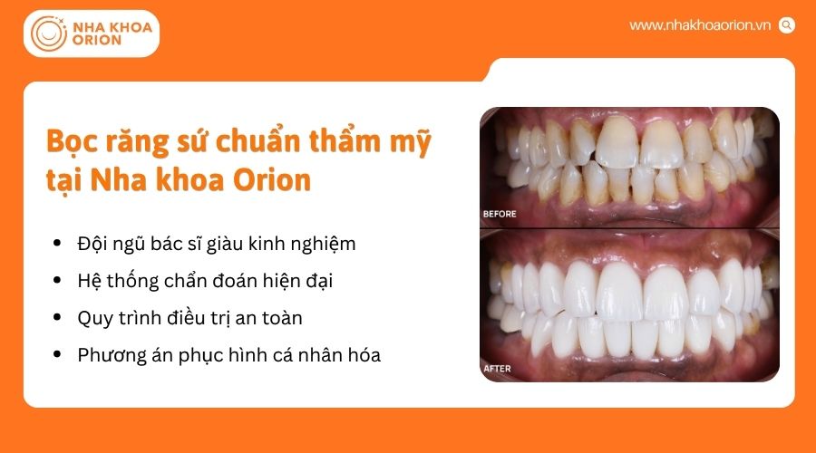 Nha khoa Orion cung cấp giải ph&aacute;p bọc sứ an to&agrave;n, ph&ugrave; hợp từng t&igrave;nh trạng răng