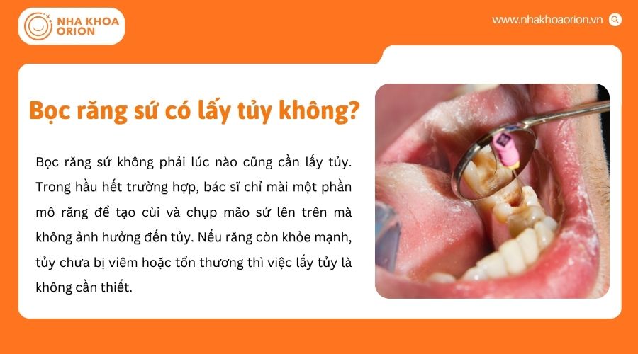 B&aacute;c sĩ sẽ chỉ định lấy tủy dựa tr&ecirc;n t&igrave;nh trạng v&agrave; mức độ tổn thương răng