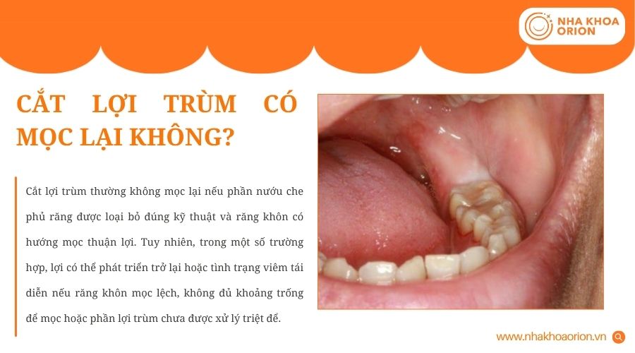 Lợi trùm có thể tái phát nếu nguyên nhân gây viêm chưa được xử lý triệt để