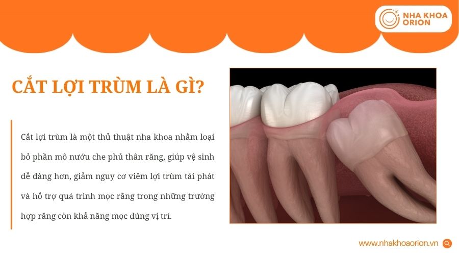 Cắt lợi trùm là thủ thuật loại bỏ phần nướu che phủ thân răng, giúp răng mọc thuận lợi hơn