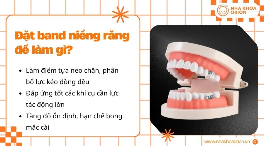 Band niềng răng gi&uacute;p ph&acirc;n bổ lực k&eacute;o, cố định kh&iacute; cụ mạnh v&agrave; hạn chế bong mắc c&agrave;i
