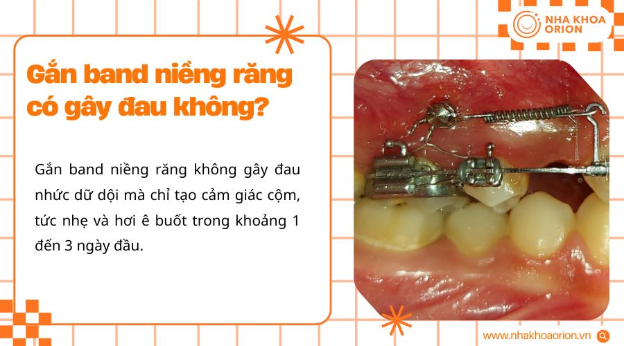 Gắn band niềng răng chỉ g&acirc;y cộm nhẹ, kh&ocirc;ng đau nhức dữ dội như nhiều người lo ngại