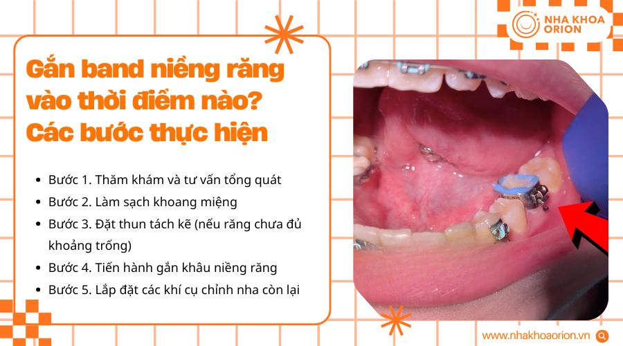 Band niềng răng thường được gắn ở giai đoạn đầu trong qu&aacute; tr&igrave;nh niềng răng