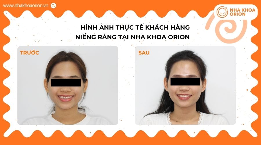 Khách hàng có tình trạng răng hô và cắn hở, được cải thiện sau 2 năm chỉnh nha