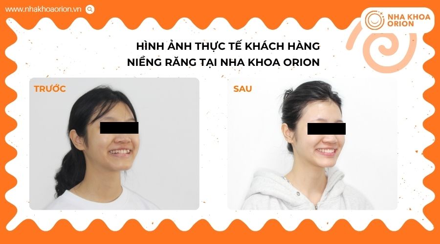Khách hàng cải thiện tình trạng răng lệch lạc sau chỉnh nha