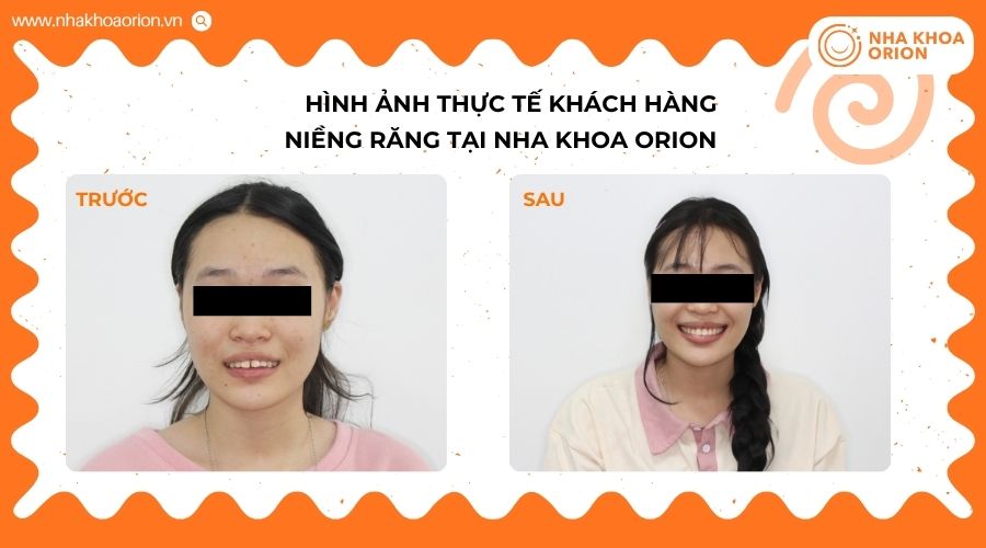 Khách hàng có tình trạng cắn hở và răng thưa, được cải thiện sau 2,5 năm chỉnh nha