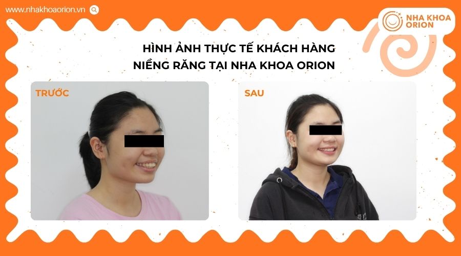 Khách hàng có tình trạng hô hai hàm, được cải thiện sau 2 năm chỉnh nha