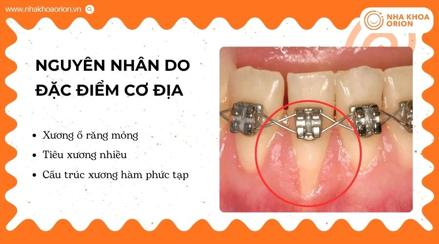 Đặc điểm xương hàm có thể ảnh hưởng đến kết quả niềng răng