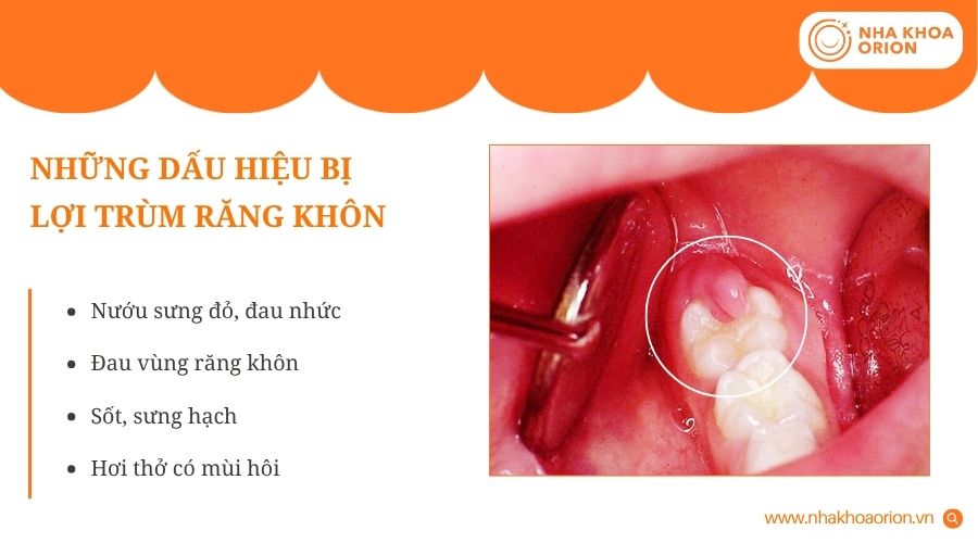 Lợi trùm răng khôn thường gây sưng đau, viêm nhiễm và nhiều triệu chứng khó chịu