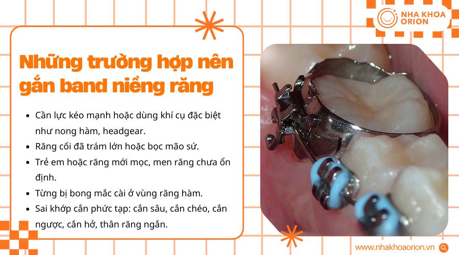 B&aacute;c sĩ chỉ định gắn band cho c&aacute;c ca cần lực k&eacute;o mạnh hoặc răng c&oacute; t&igrave;nh trạng đặc biệt