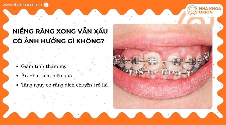 Niềng răng không đạt kết quả có thể gây nhiều ảnh hưởng lâu dài