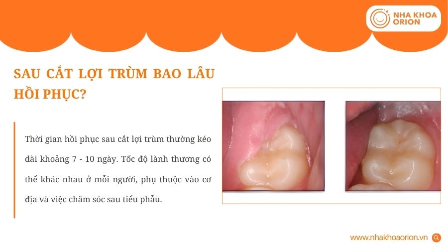 Thời gian hồi phục thay đổi tùy vào cơ địa và cách chăm sóc sau tiểu phẫu