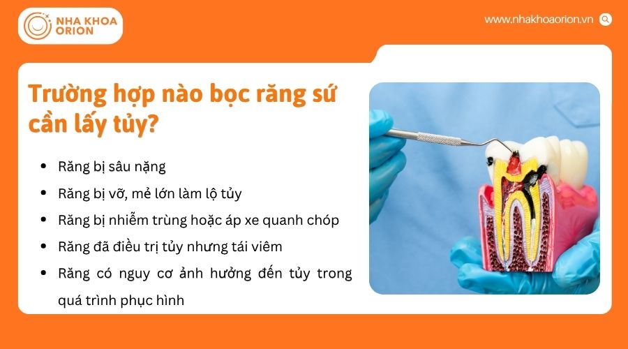 Răng s&acirc;u nặng, vi&ecirc;m tủy, vỡ lớn hoặc nhiễm tr&ugrave;ng cần điều trị tủy trước khi bọc sứ