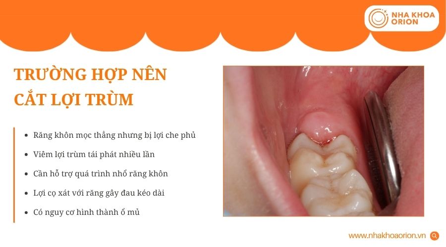 Cắt lợi trùm thường được chỉ định khi nướu gây đau, viêm hoặc cản trở mọc răng