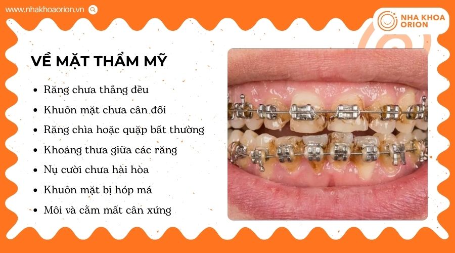 Nụ cười và khuôn mặt là dấu hiệu dễ nhận biết khi niềng răng thất bại
