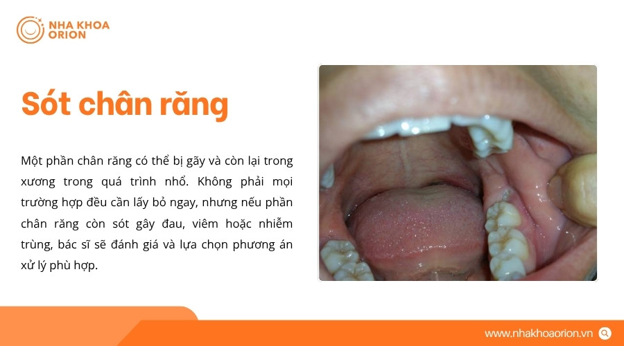 Phần ch&acirc;n răng c&ograve;n lại c&oacute; thể g&acirc;y đau hoặc vi&ecirc;m nếu ph&aacute;t sinh vấn đề sau thủ thuật
